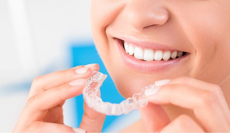Aligners