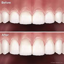 Crown lengthening